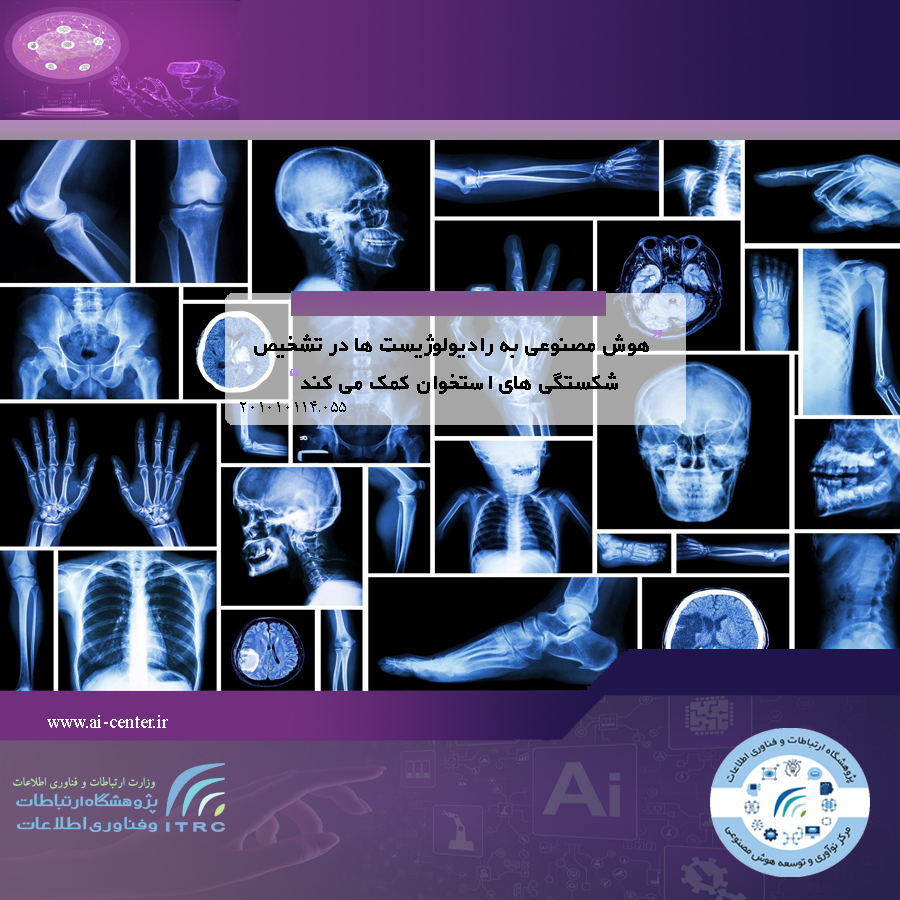هوش مصنوعی به رادیولوژیست ها در تشخیص شکستگی های استخوان کمک می کند