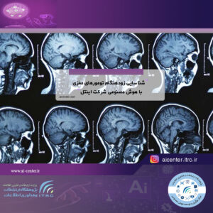 شناسایی زودهنگام تومورهای مغزی با هوش مصنوعی شرکت اینتل