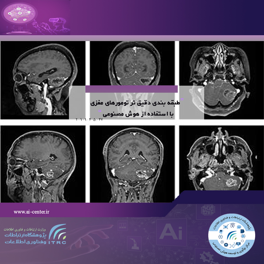 طبقه بندی دقیق تر تومورهای مغزی با استفاده از هوش مصنوعی